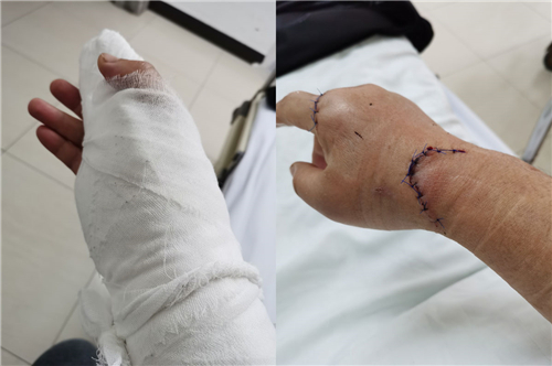 扬州市公安局江都分局浦头派出所所长张秋救火受伤